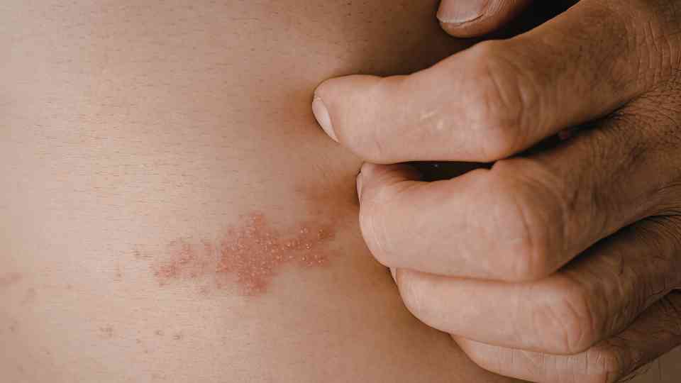 person scratching rash