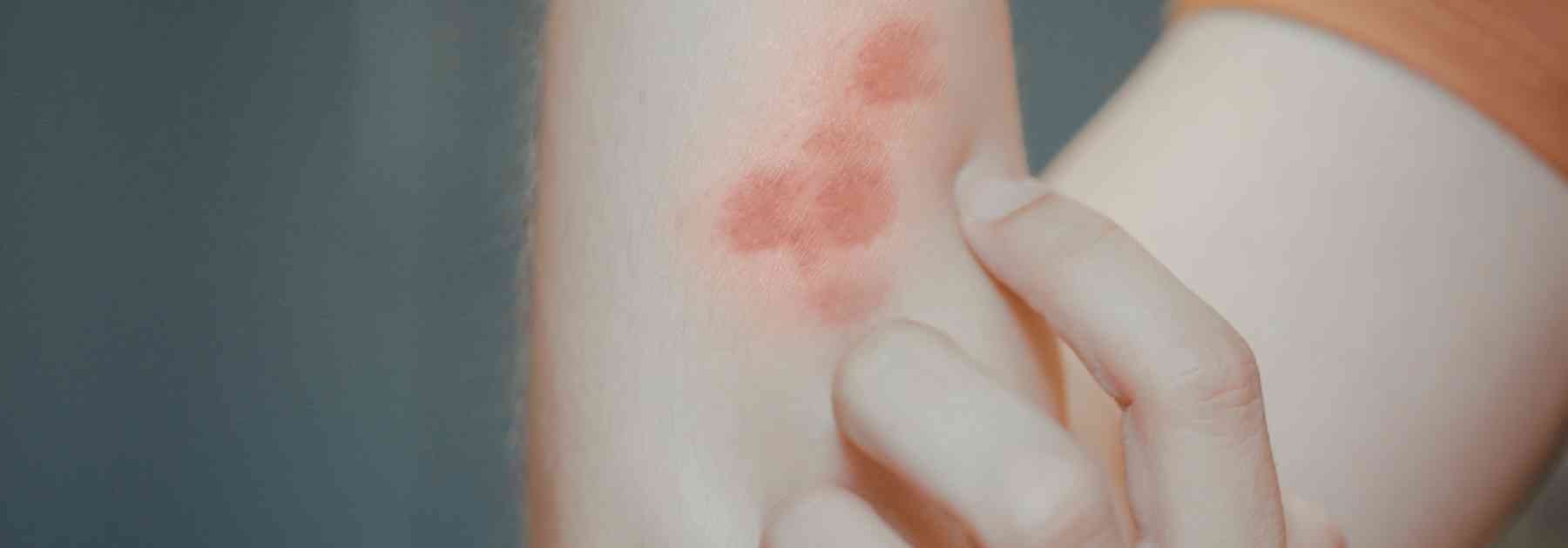 person scratching rash on their arm